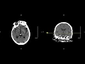 Unremarkable Non-Contrast Head CT Axial Scan - Example 1