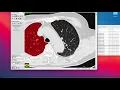 Deep Learning segmentation Mask Preparation for the CT scan image lungs using ITK Snap