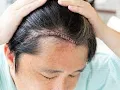 Craniectomy CPT code - simplify medical coding
