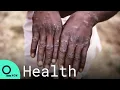 Monkeypox Virus What Are Symptoms Who s at Risk