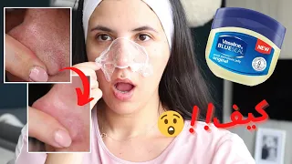 الفازلين يزيل الرؤوس السوداء مش عم بمزح 