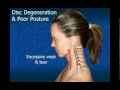 Download Lagu Cervical Disc Degeneration
