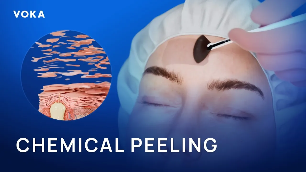 VOKA chemical peeling animation