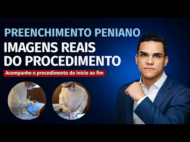 Vídeo do Dr. Rafael Correia sobre preenchimento peniano com ácido hialurônico