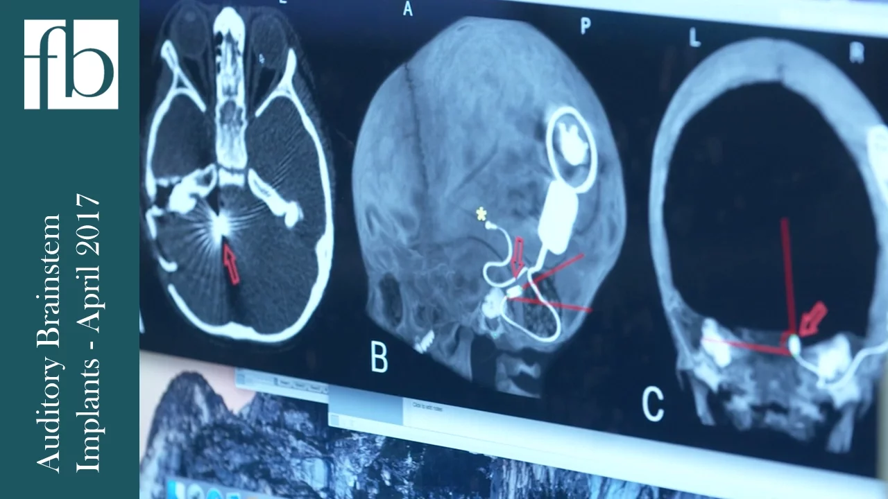 Advances in Auditory Brainstem Implants