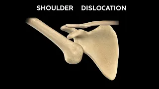 Shoulder Dislocation and Its Types: Everything You Need To Know   Dr  Nabil Ebraheim