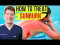 Doctor explains HOW TO TREAT SUNBURN Top 5 things to do avoid to help your skin