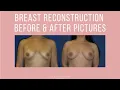 Breast Reconstruction Before After Pictures Photo Gallery