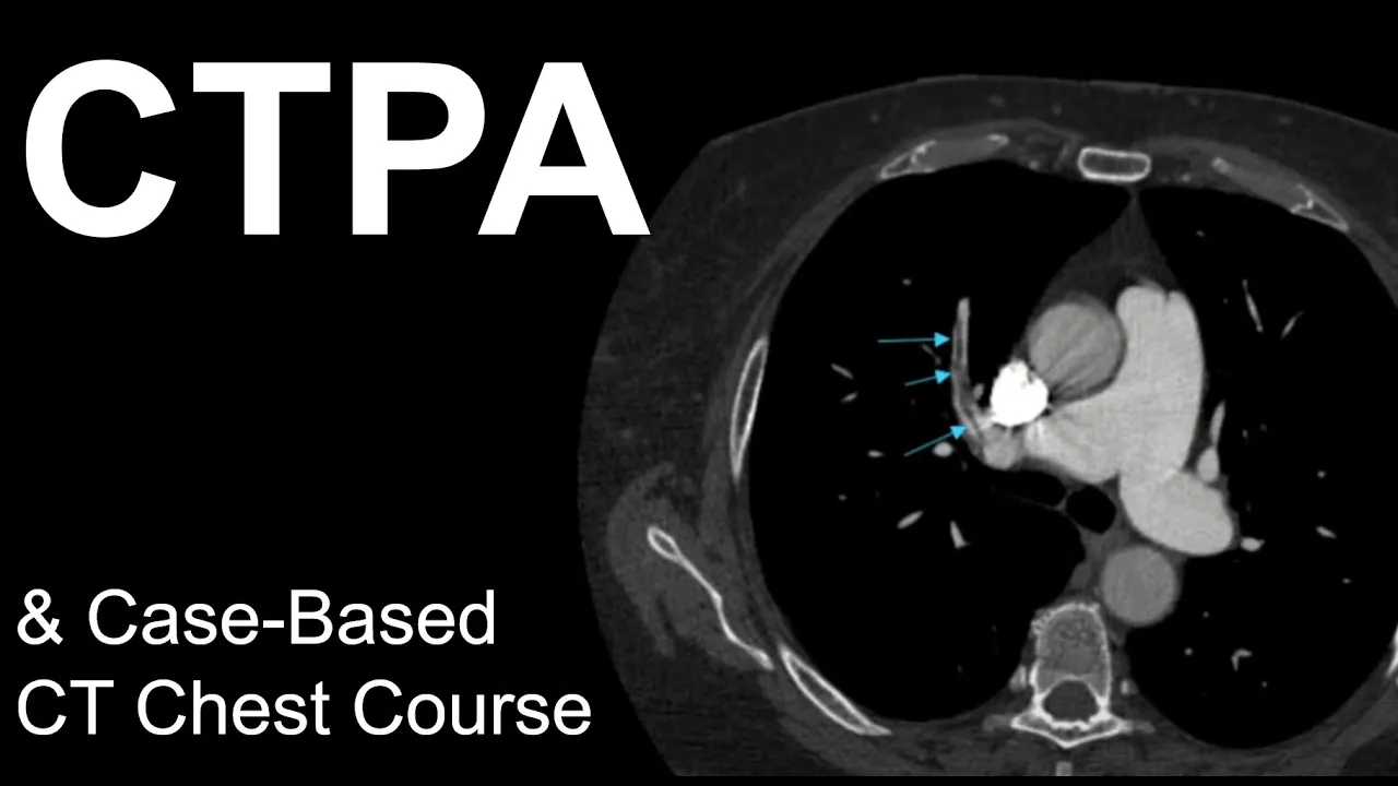 CT Pulmonary Angiogram: Pulmonary Embolism, Case-Based Course