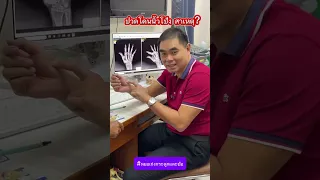  ทำไมนิ้วมือถึงเจ็บ โดยเฉพาะเวลาขยับหัวแม่มือ และมีอาการบวมหรือปวดที่ข้อ มือ 