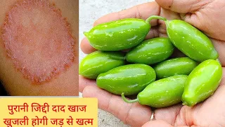 पुरानी दाद खुजली,चर्म रोग ,धाव ,मधुमेह, गठिया पहले दिन से ही फायदा शुरू/ कुंदरू के फायदे