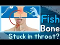 What to Do When a Fish Bone Gets Stuck in Your Throat