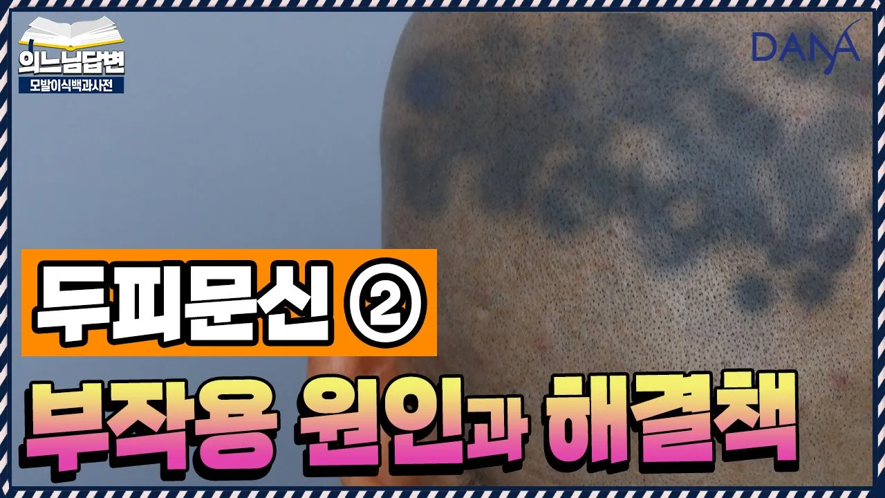의느님답변📂두피문신 하기 전에 꼭 알아야 할 것들ㅣ두피문신 후 푸르스름하게 보여요②ㅣ다나성형외과(DANA)ㅣ모발이식ㅣ헤어라인교정ㅣ두피문신ㅣ탈모치료