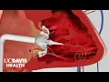 Minimally Invasive Procedures for Structural Heart Disease UC Davis Medical Center