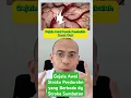 Gejala Awal Pecah Pembuluh Darah Otak atau Stroke Perdarahan yg berbeda dg Stroke Sumbatan