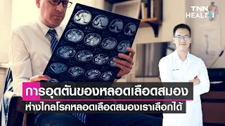 ควรรีบไปโรงพยาบาลเมื่อใดหากสงสัยเป็นโรคหลอดเลือดสมอง