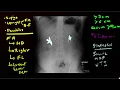 Abdominal X-rays