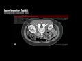 Open Inventor Toolkit Measurement on Dicom dataset 3D Visualization Toolkit