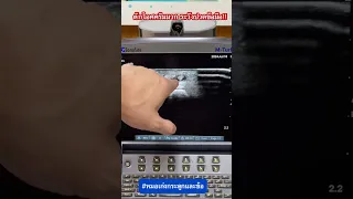  ทำไมมือถึงปวดเวลาตักไอศครีม และเกิดอะไรขึ้นกับเอ็นที่มือ 