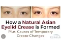 Causes of Natural Asian Double Eyelids Becoming Temporary Monolids and Making it More Consistent