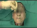 Download Lagu 1.4 Step 1: Skin Incisions