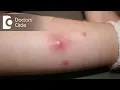 Diagnosis and management of boil on buttock area - Dr Rasya Dixit