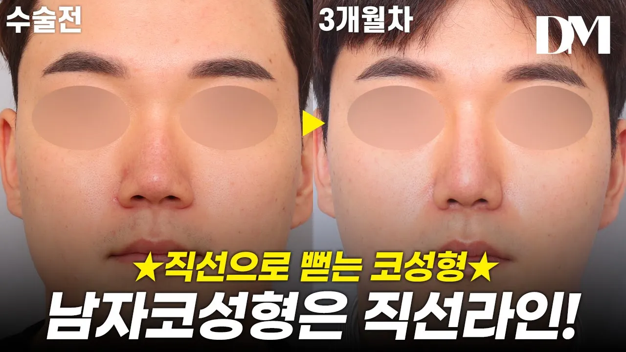 달라진 콧대, 코끝으로 이미지 변신! #눈성형 #코성형 #뒷트임