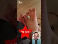 Download Lagu DOCTOR REACTS - PLANTAR WARTS \u0026 DUCT TAPE!😱 #shorts #reaction