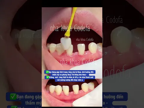 đóng khe thưa - không mài răng #nhakhoacodofa #dentist #răngsứthẩmmỹ #veneers