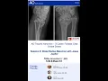 Download Lagu AO Trauma Hand NA-3 Cases : Distal Radius Malunion with Jesse Jupiter – Marco Rizzo, MD