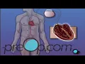 Permanent Pacemaker Implant Surgery - PreOp®  Patient Education