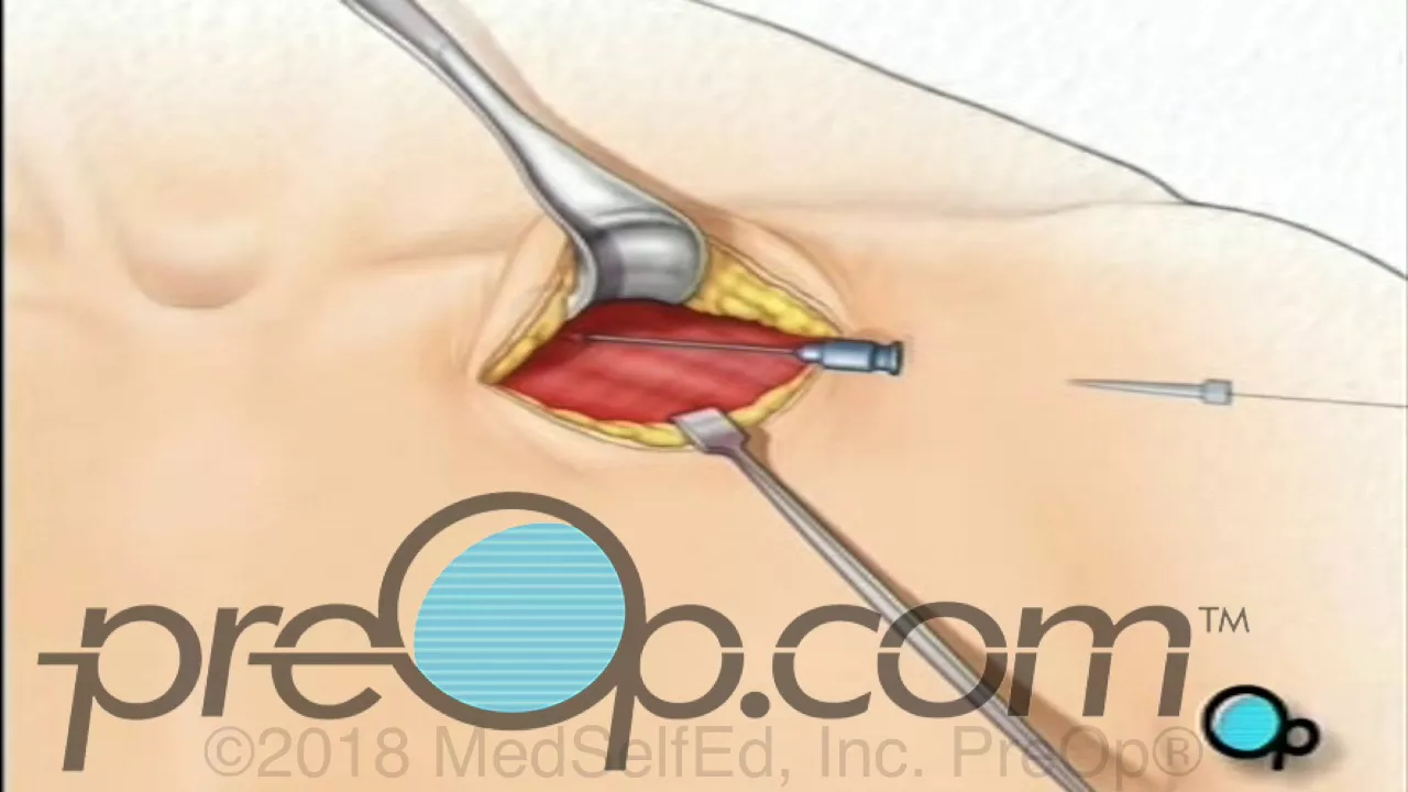Permanent Pacemaker Implant Surgery - PreOp® Patient Education