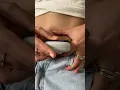 Changing my insulin pump infusion set