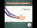 HOW TO USE ADRENALINE EPINEPHRINE IN ANAPHYLAXIS