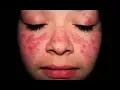 Download Lagu De behandeling van systemische lupus erythematodes (SLE)