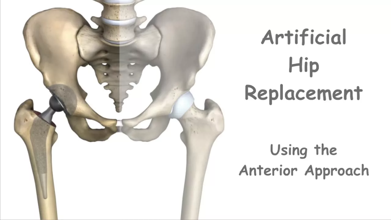 Artificial Hip Replacement - Anterior Approach