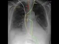 Chest X-ray Lines and Tubes in 5 minutes