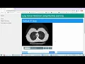 AE041 Lung Cancer Detection Using CNN