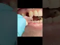 Flipper - Quick Temporary Replacement of a Missing Tooth
