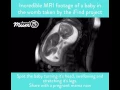 MRI Scan of Baby Moving in Womb Channel Mum