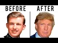 Donald Trump s Hair Transplant Plastic Surgery Analysis