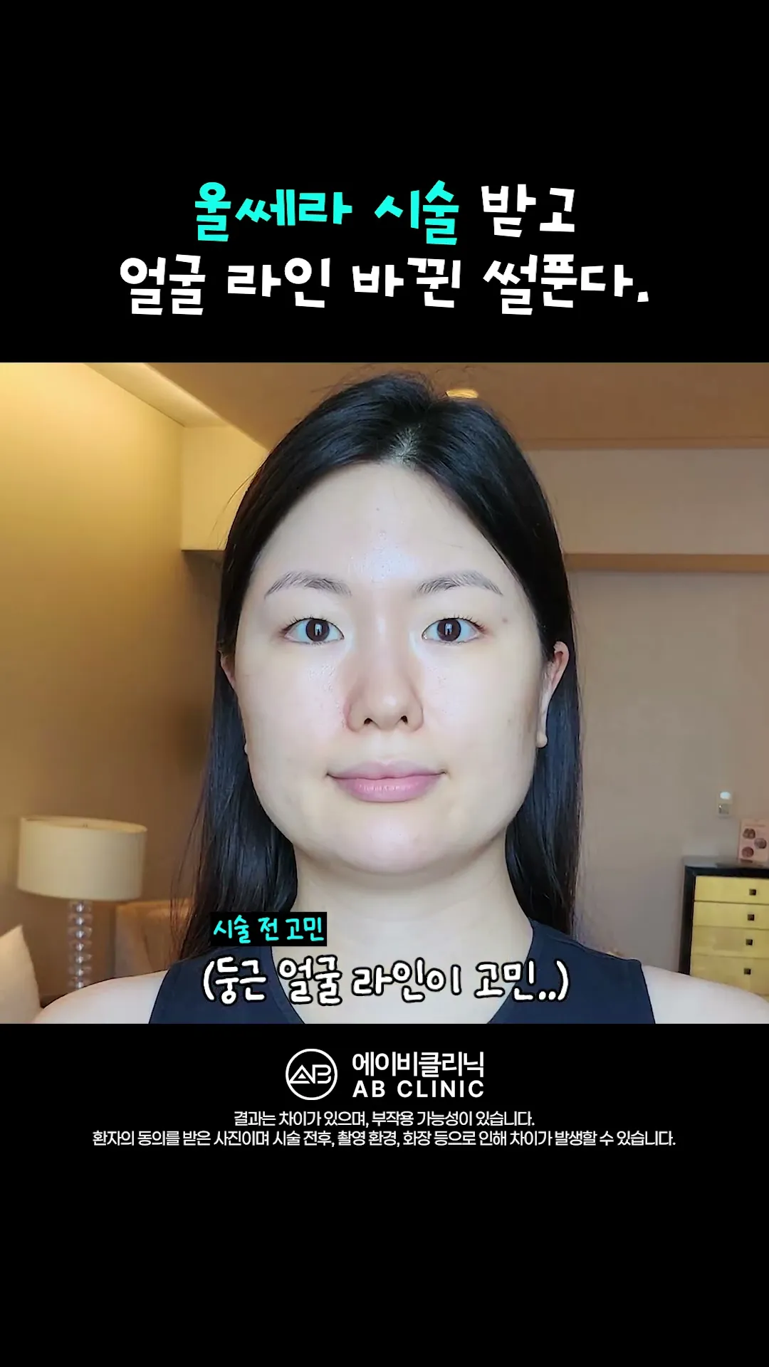 둥글고 각진 얼굴, 울쎄라로 해결