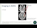 Hypoparathyroidism - The Critical Role of Genetics in Your Differential Diagnosis