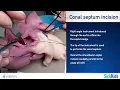 Download Lagu Modified Konno procedure - HOST (Hands-On Surgical Training) completed by Dr Osami Honjo