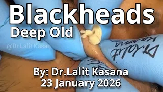 Deep Old Blackhead Removal by Dr.Lalit Kasana (23 January 2026)