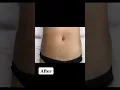 Stretch Marks Inkless Removal Boleyn Treatment Los Angeles