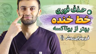 حذف خط خنده با روش های خانگی Laugh Lines Removal 
