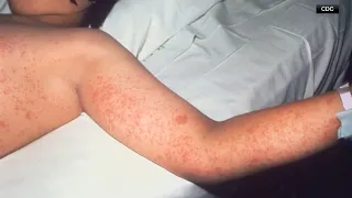 Kentucky health s suspect measles outbreak after new case confirmed in Christian County