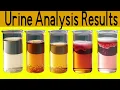 Urine Analysis how to read urine test simple