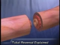 Tubal Ligation Tubes Tied